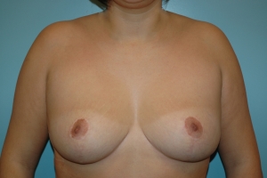 Cas 5 réduction mammaire après vue de face