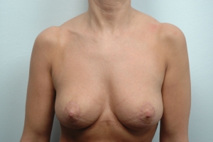 Cas 4 lifting des seins après vue de face