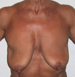 Cas 5 lifting des seins avant vue de face