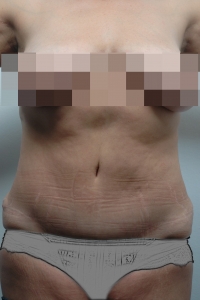 Cas 3 plastie abdominale après vue de face