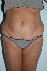 Cas 3 plastie abdominale avant vue de face