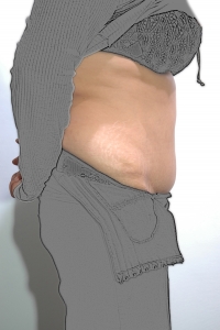 Cas 5 plastie abdominale après vue de profil