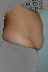 Cas 5 plastie abdominale avant vue de profil