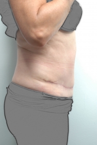 Cas 6 plastie abdominale après vue de profil
