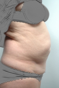 Cas 6 plastie abdominale avant vue de profil