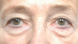 Cas 1 blépharoplastie des 4 paupières avant