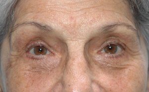 Cas 2 blépharoplastie des paupières inférieures après