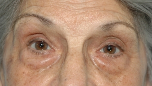 Cas 2 blépharoplastie des paupières inférieures avant