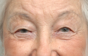 Cas 4 blépharoplastie des paupières supérieures avant