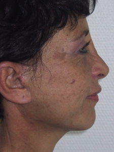 Cas 2 lifting cervico-facial après vue de profil droit