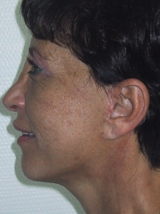 Cas 2 lifting cervico-facial après vue de profil gauche