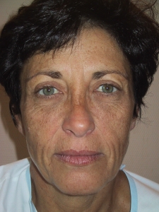 Cas 2 lifting cervico-facial avant vue de face