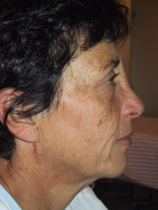 Cas 2 lifting cervico-facial avant vue de profil droit