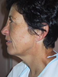 Cas 2 lifting cervico-facial avant vue de profil gauche