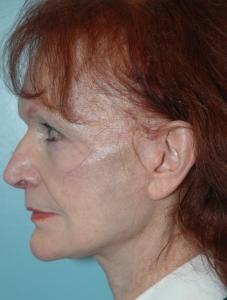 Cas 3 lifting cervico-facial après vue de profil