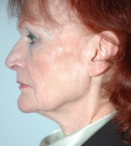 Cas 3 lifting cervico-facial avant vue de profil