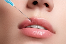 Traitement des lèvres par injection d'acide hyaluronique