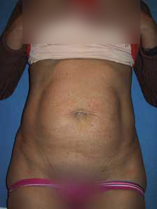 Abdominoplastie, chirurgie esthétique réparatrice à Montpellier Sète