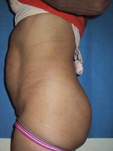 Abdominoplastie, vue de profil avant opération