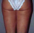 Lipoaspiration (ou liposuccion), après opération, Montpellier