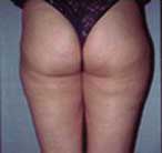 Lipoaspiration (ou liposuccion), avant opération, Montpellier