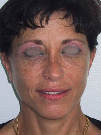 Lifting cervico facial, après l'opération, vue de face