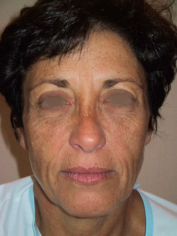 Lifting cervico facial, avant l'opération, vue de face