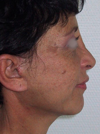 Lifting cervico facial, après l'opération, vue de profil