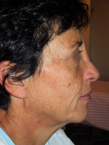 Lifting cervico facial, avant l'opération, vue de profil