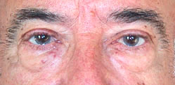 Avant blépharoplastie à Montpellier