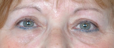 Ectropion apres blepharoplastie